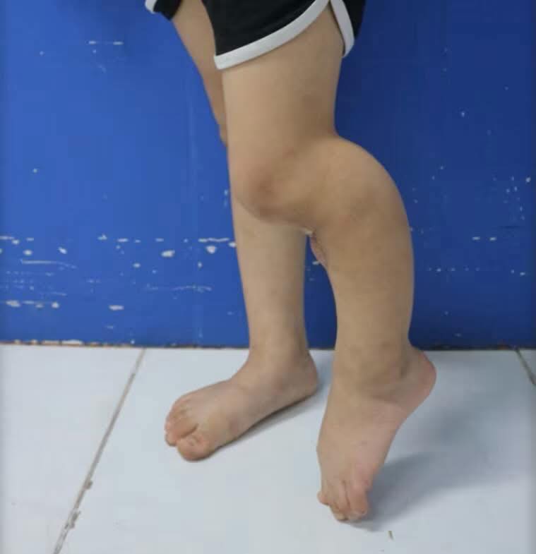 Chân của cháu bé biến dạng trước khi thực hiện phẫu thuật chuyển xương, chỉnh trục